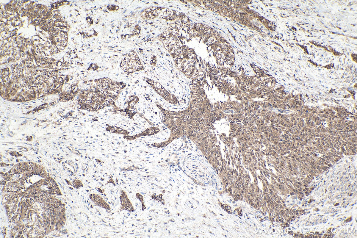 Immunohistochemical analysis of paraffin-embedded human urothelial carcinoma tissue slide using KHC1611 (RXRG IHC Kit).