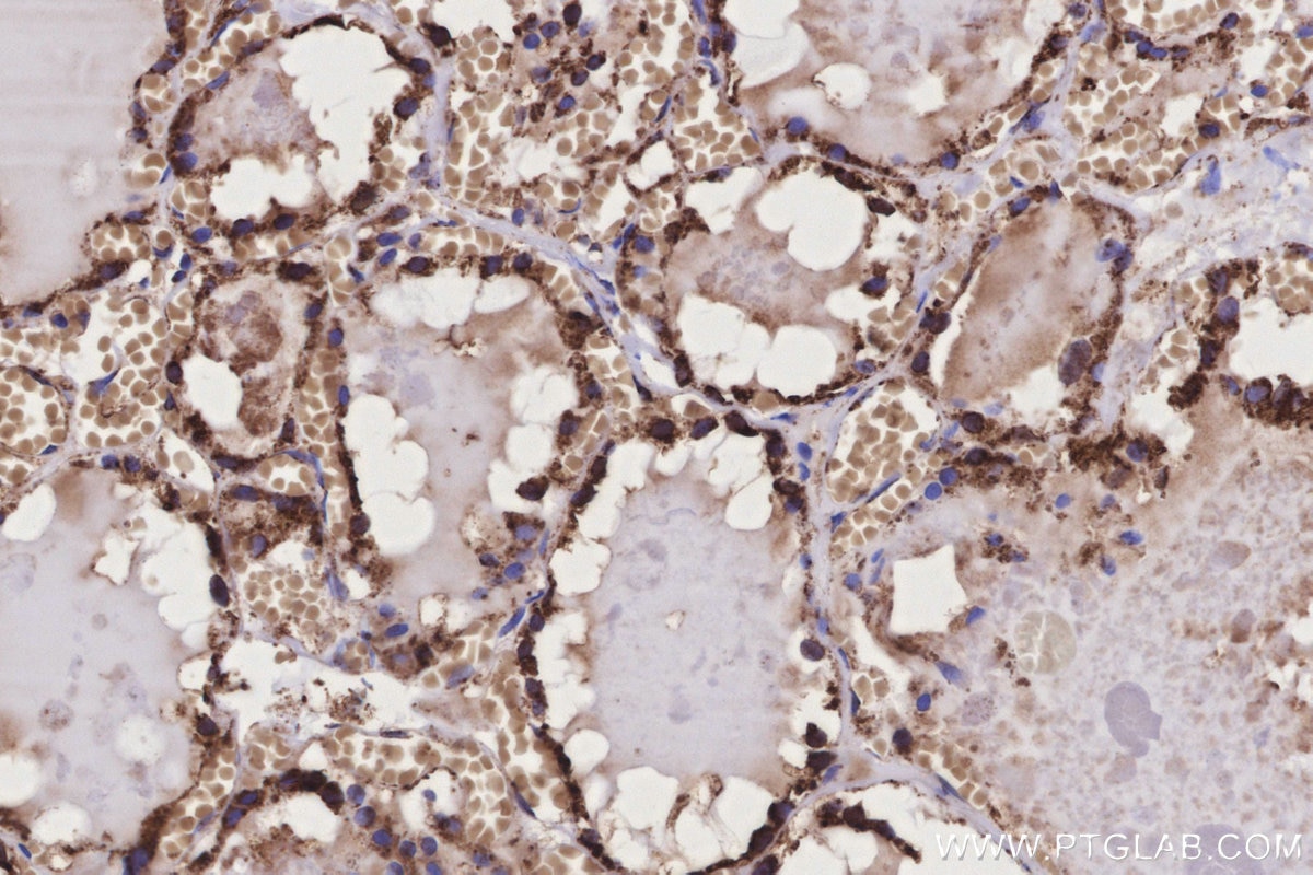 Immunohistochemical analysis of paraffin-embedded human thyroid cancer tissue slide using KHC3169 (Ribophorin I IHC Kit).