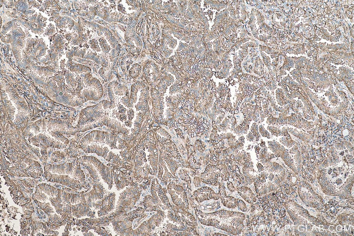 Immunohistochemical analysis of paraffin-embedded human lung cancer tissue slide using KHC0528 (S100A10 IHC Kit).