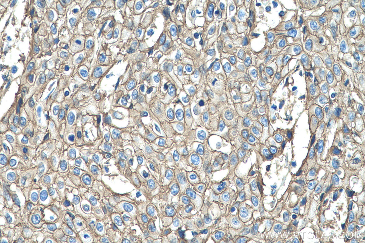 Immunohistochemical analysis of paraffin-embedded human cervical cancer tissue slide using KHC0528 (S100A10 IHC Kit).