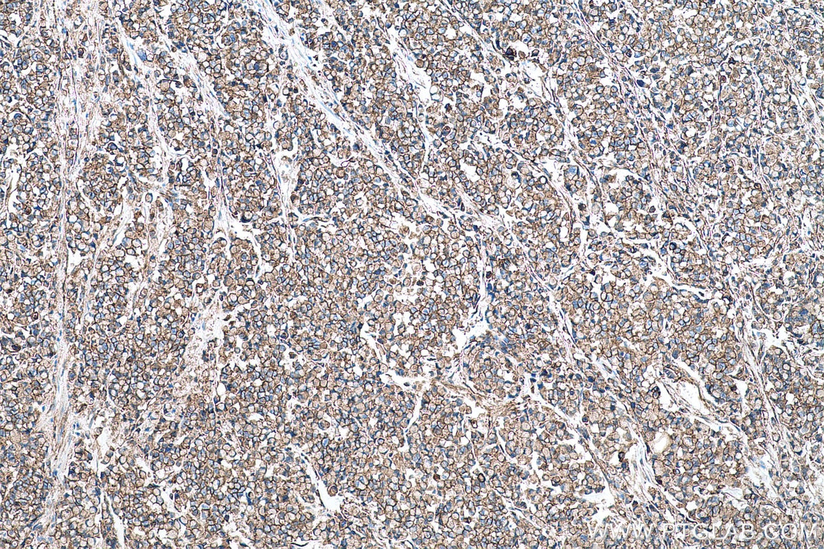 Immunohistochemical analysis of paraffin-embedded human colon cancer tissue slide using KHC0528 (S100A10 IHC Kit).