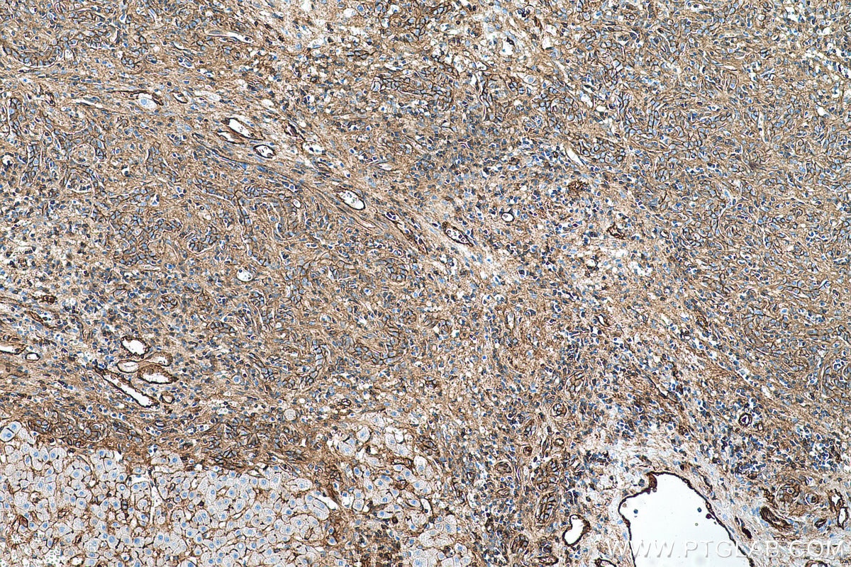Immunohistochemical analysis of paraffin-embedded human liver cancer tissue slide using KHC0528 (S100A10 IHC Kit).