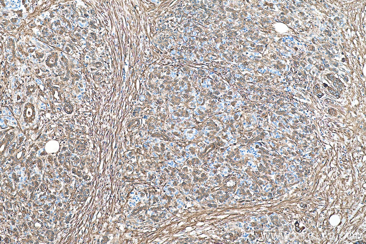 Immunohistochemical analysis of paraffin-embedded human pancreas cancer tissue slide using KHC0528 (S100A10 IHC Kit).