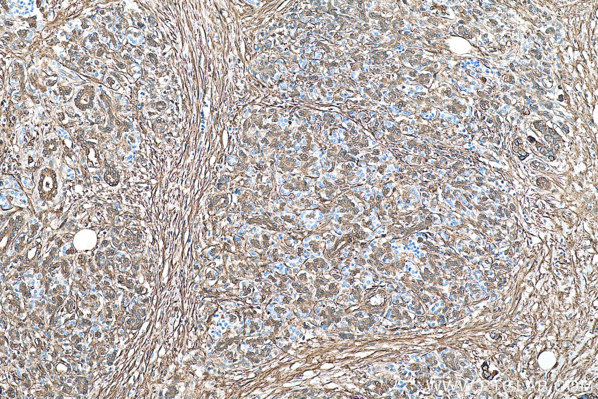 Immunohistochemical analysis of paraffin-embedded human pancreas cancer tissue slide using KHC0528 (S100A10 IHC Kit).
