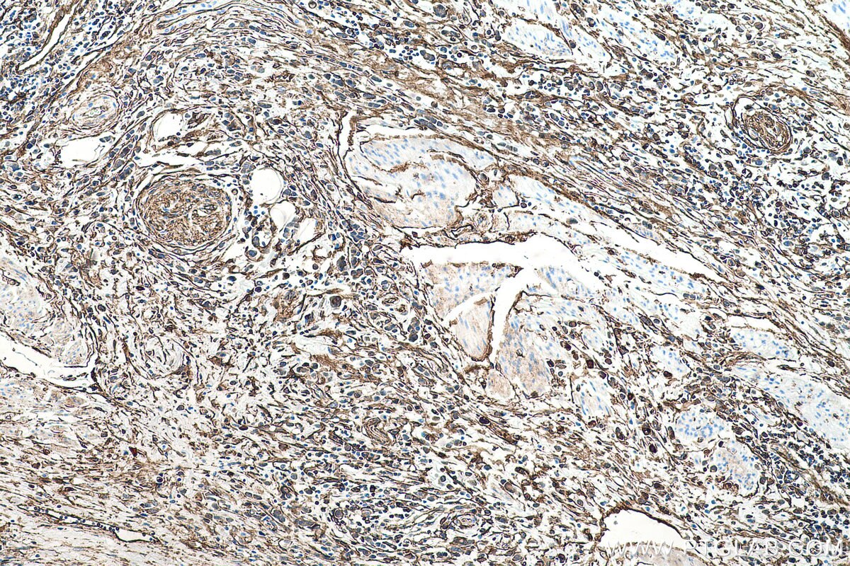 Immunohistochemical analysis of paraffin-embedded human stomach cancer tissue slide using KHC0528 (S100A10 IHC Kit).