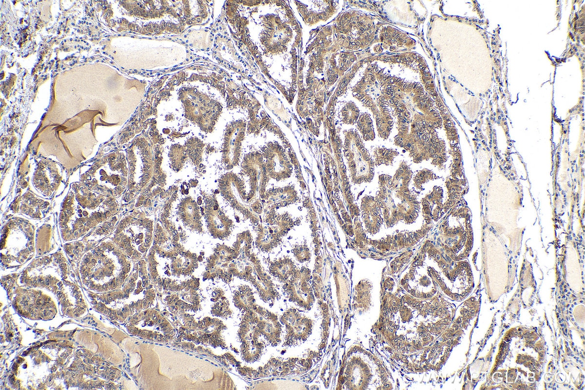 Immunohistochemical analysis of paraffin-embedded human thyroid cancer tissue slide using KHC0550 (S100A11 IHC Kit).