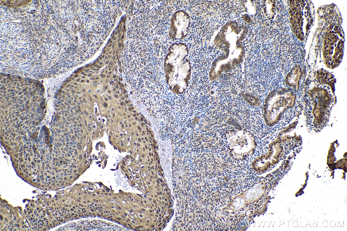 Immunohistochemical analysis of paraffin-embedded human cervical cancer tissue slide using KHC0550 (S100A11 IHC Kit).