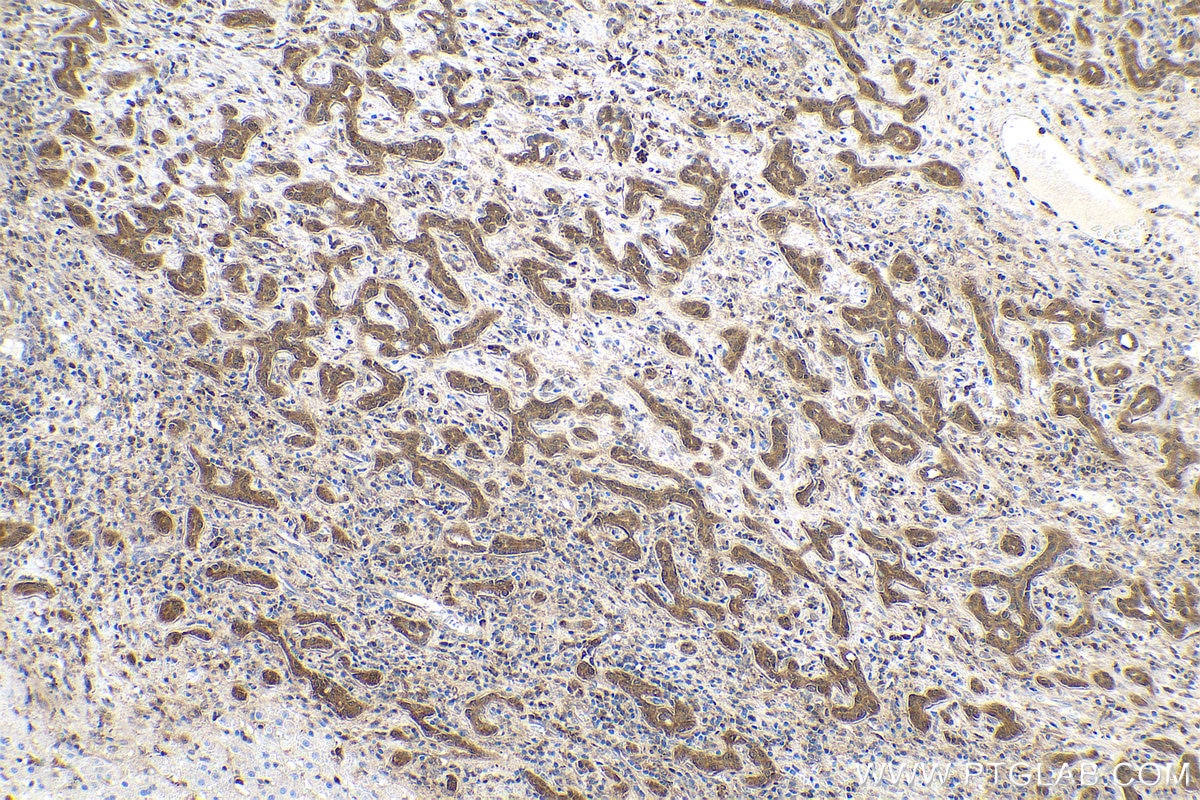 Immunohistochemical analysis of paraffin-embedded human liver cancer tissue slide using KHC0550 (S100A11 IHC Kit).
