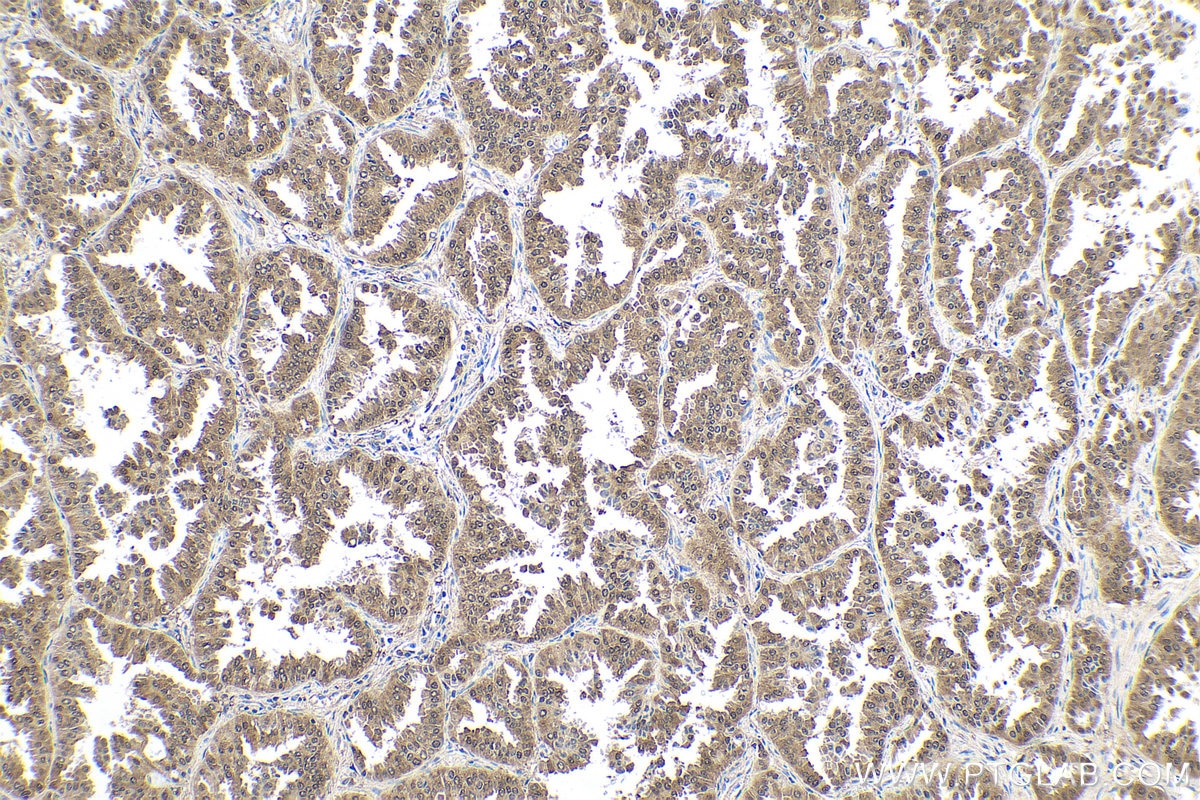 Immunohistochemical analysis of paraffin-embedded human lung cancer tissue slide using KHC0550 (S100A11 IHC Kit).