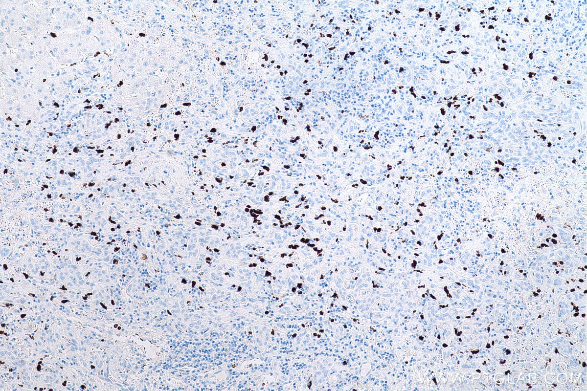 Immunohistochemical analysis of paraffin-embedded human liver cancer tissue slide using KHC0581 (S100A12 IHC Kit).