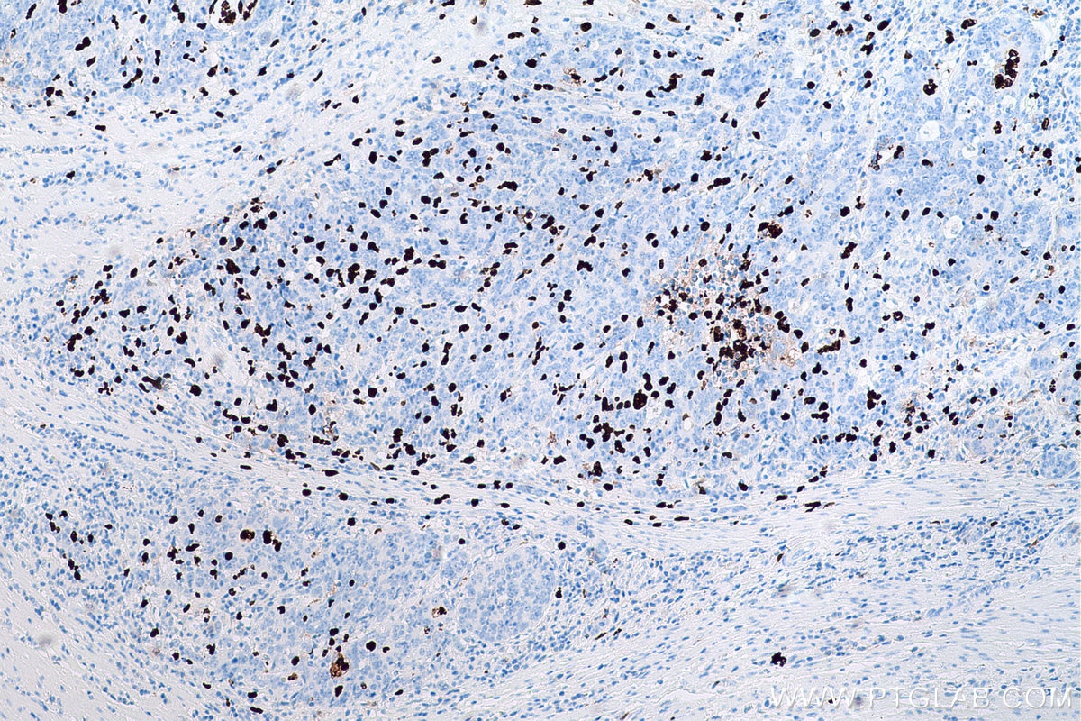 Immunohistochemical analysis of paraffin-embedded human colon cancer tissue slide using KHC0581 (S100A12 IHC Kit).