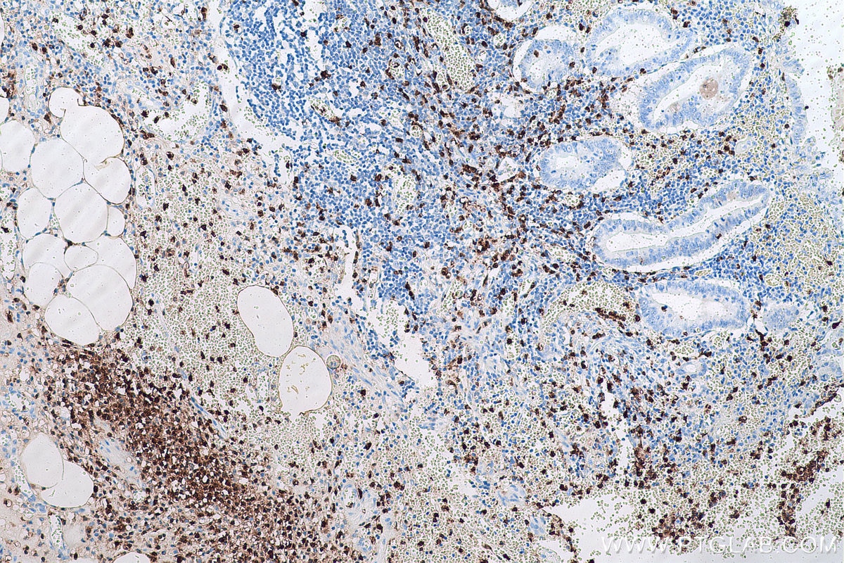 Immunohistochemical analysis of paraffin-embedded human appendicitis tissue slide using KHC0581 (S100A12 IHC Kit).