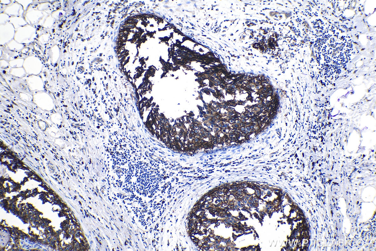 Immunohistochemical analysis of paraffin-embedded human breast cancer tissue slide using KHC1192 (S100A14 IHC Kit).