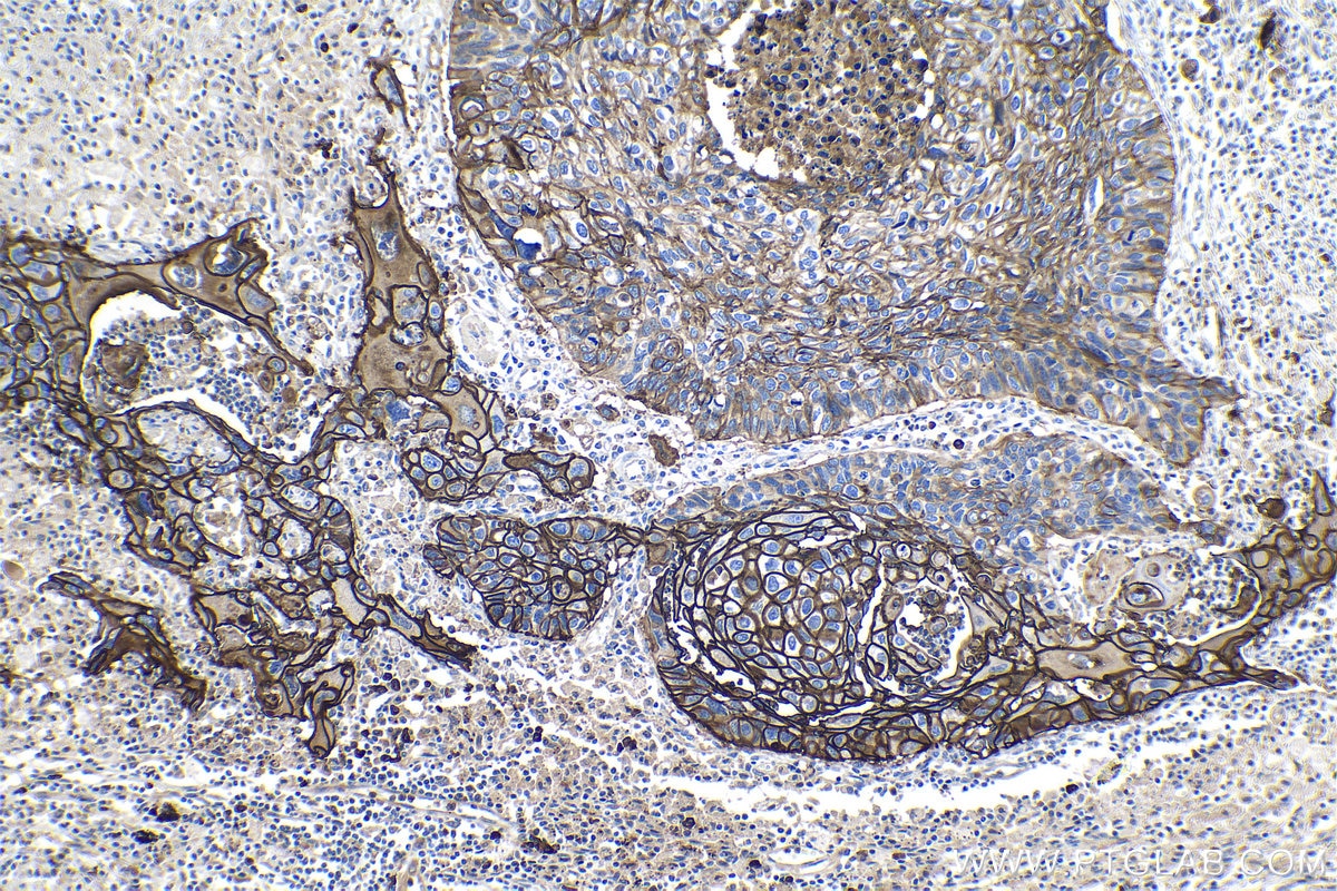 Immunohistochemical analysis of paraffin-embedded human lung cancer tissue slide using KHC1192 (S100A14 IHC Kit).