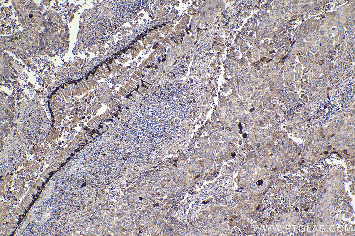 Immunohistochemical analysis of paraffin-embedded human lung cancer tissue slide using KHC2219 (S100A2 IHC Kit).