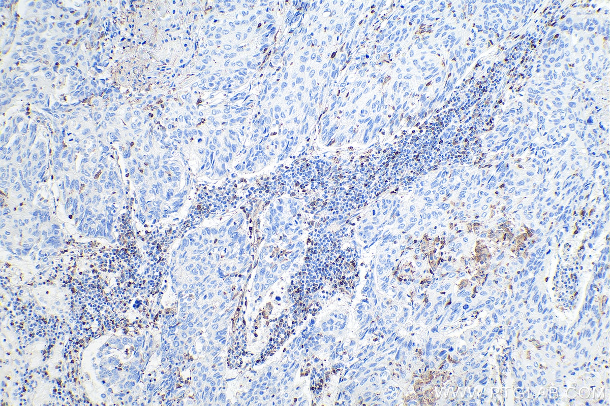 Immunohistochemical analysis of paraffin-embedded human lung cancer tissue slide using KHC0108 (S100A4 IHC Kit).
