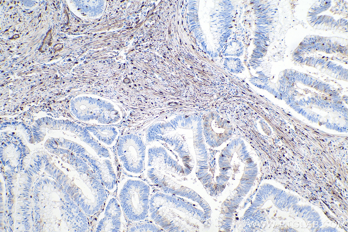 Immunohistochemical analysis of paraffin-embedded human colon cancer tissue slide using KHC0108 (S100A4 IHC Kit).