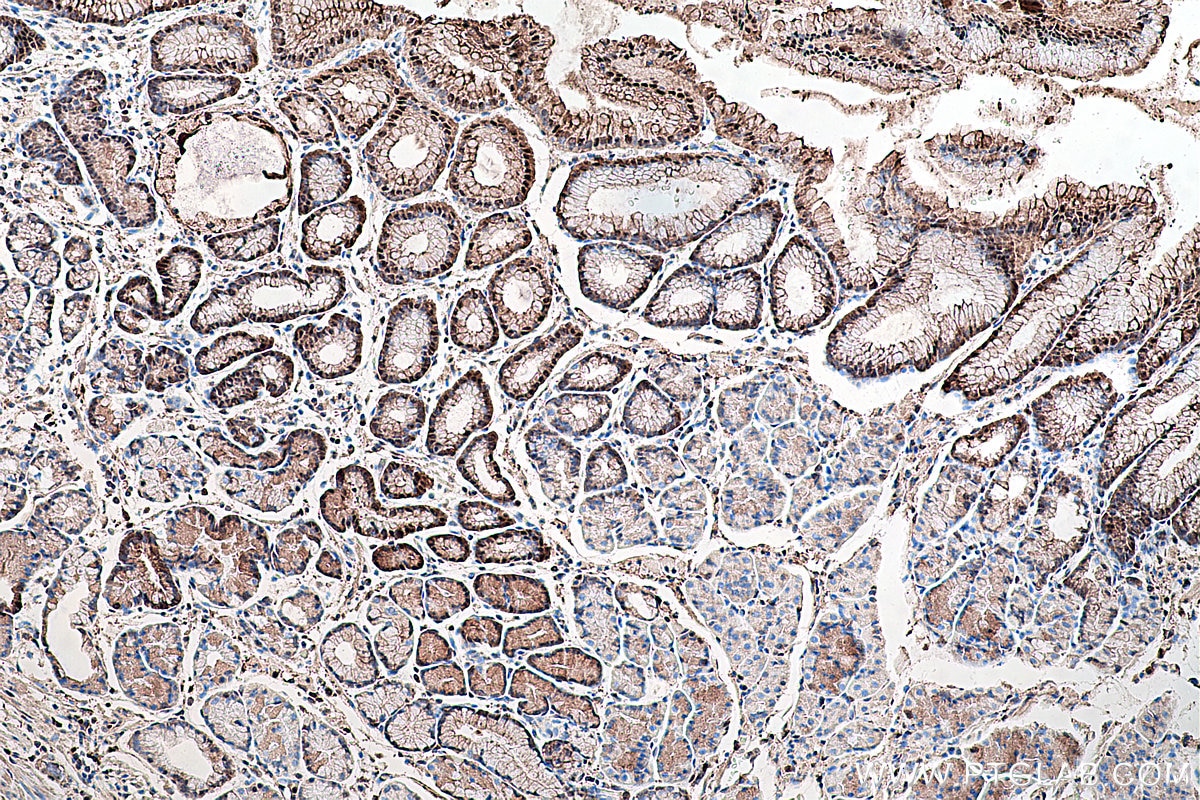 Immunohistochemical analysis of paraffin-embedded human stomach cancer tissue slide using KHC0277 (S100A6 IHC Kit).