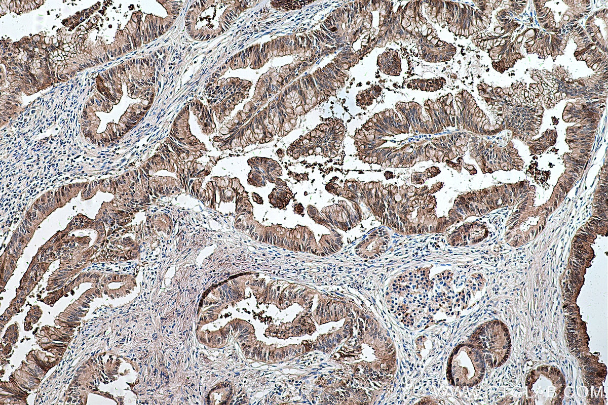 Immunohistochemical analysis of paraffin-embedded human pancreas cancer tissue slide using KHC0277 (S100A6 IHC Kit).