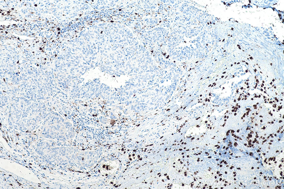 Immunohistochemical analysis of paraffin-embedded human cervical cancer tissue slide using KHC0536 (S100A8 IHC Kit).