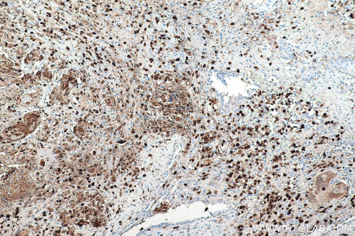 Immunohistochemical analysis of paraffin-embedded human ovary tumor tissue slide using KHC0536 (S100A8 IHC Kit).