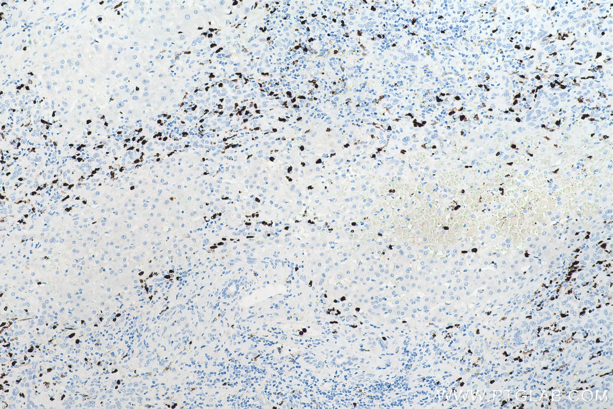 Immunohistochemical analysis of paraffin-embedded human liver cancer tissue slide using KHC0536 (S100A8 IHC Kit).