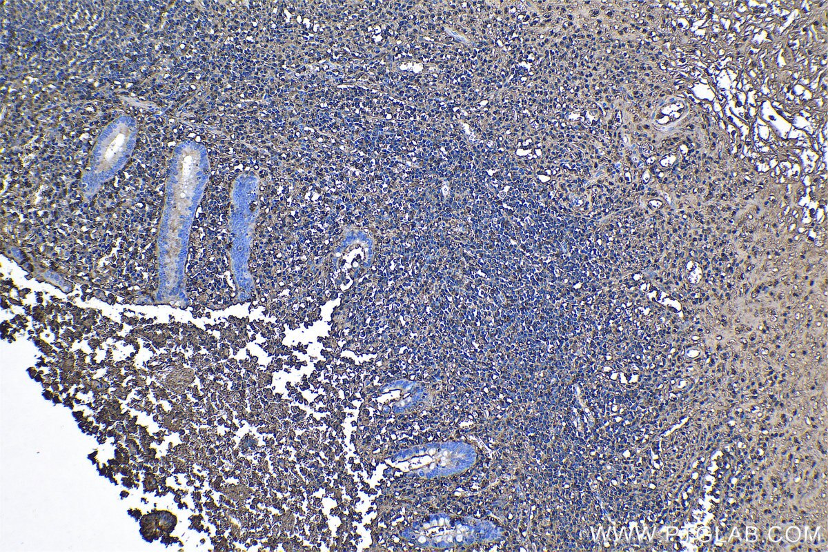 Immunohistochemical analysis of paraffin-embedded human appendicitis tissue slide using KHC1166 (S100A9 IHC Kit).
