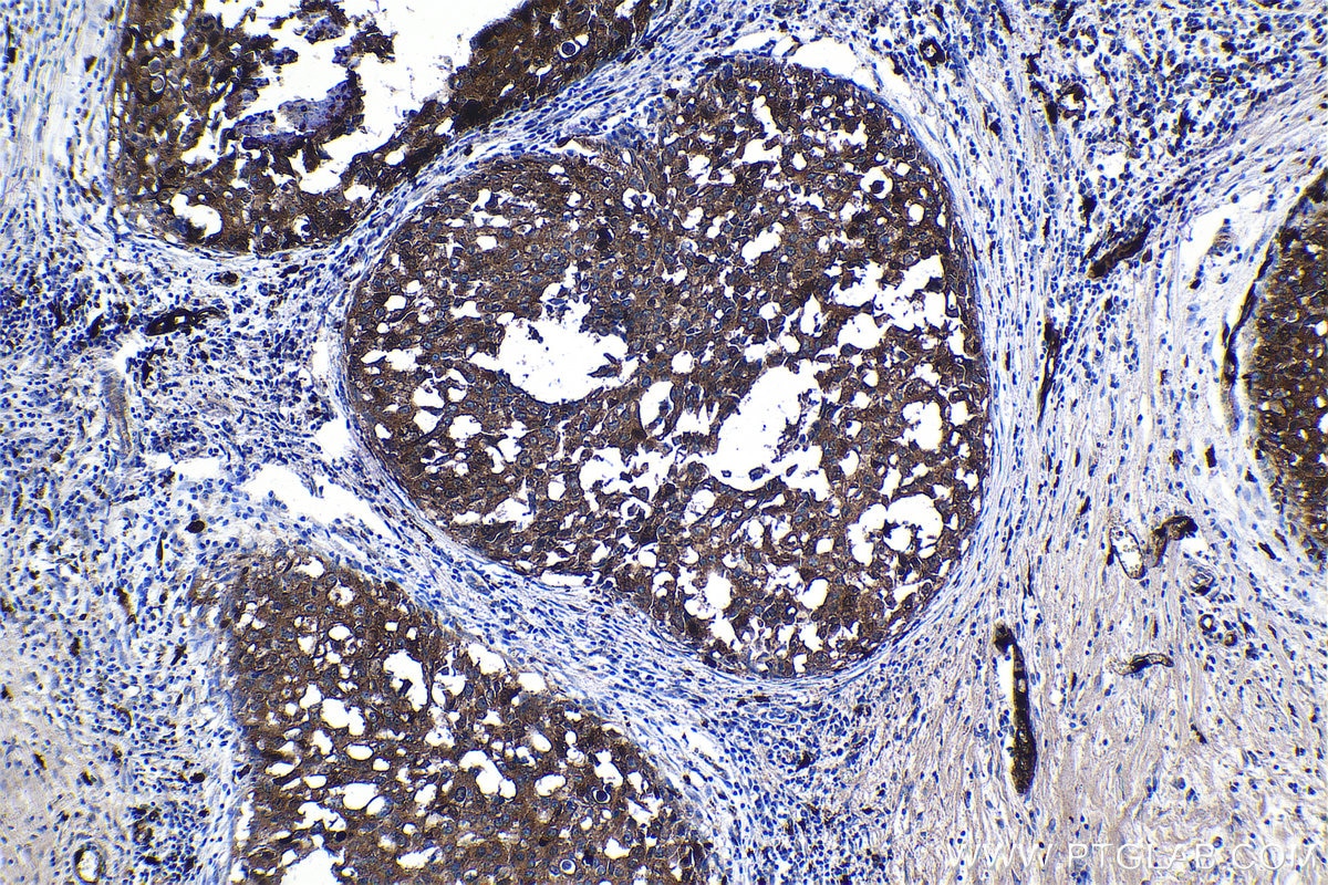 Immunohistochemical analysis of paraffin-embedded human breast cancer tissue slide using KHC1166 (S100A9 IHC Kit).