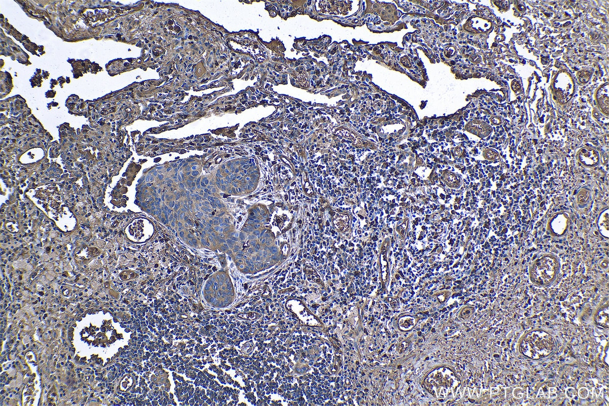 Immunohistochemical analysis of paraffin-embedded human lung cancer tissue slide using KHC1166 (S100A9 IHC Kit).