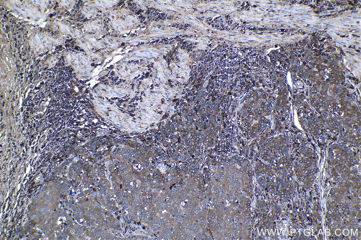 Immunohistochemical analysis of paraffin-embedded human stomach cancer tissue slide using KHC1166 (S100A9 IHC Kit).