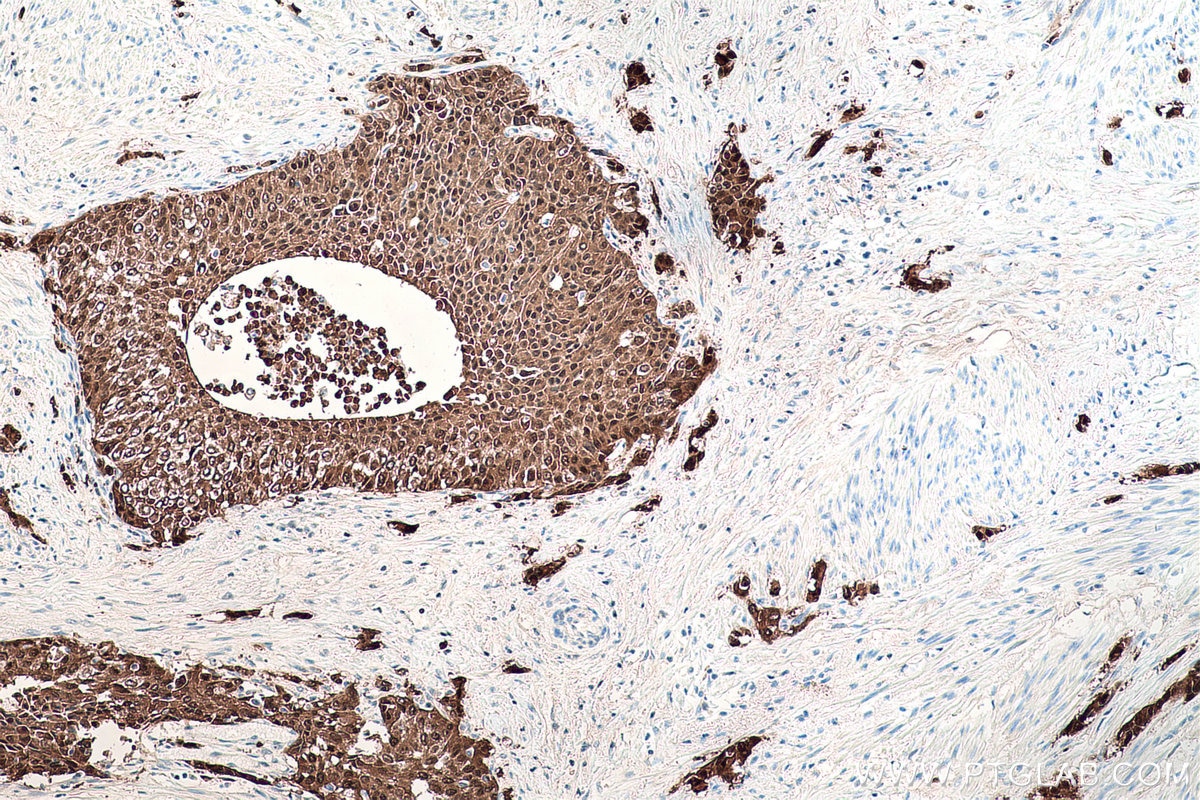 Immunohistochemical analysis of paraffin-embedded human urothelial carcinoma tissue slide using KHC0192 (S100P IHC Kit).