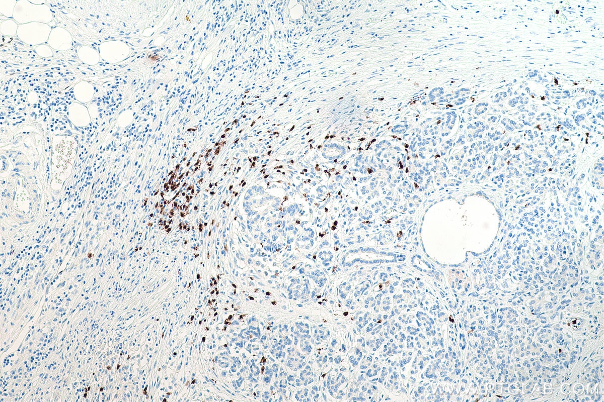 Immunohistochemical analysis of paraffin-embedded human pancreas cancer tissue slide using KHC0192 (S100P IHC Kit).