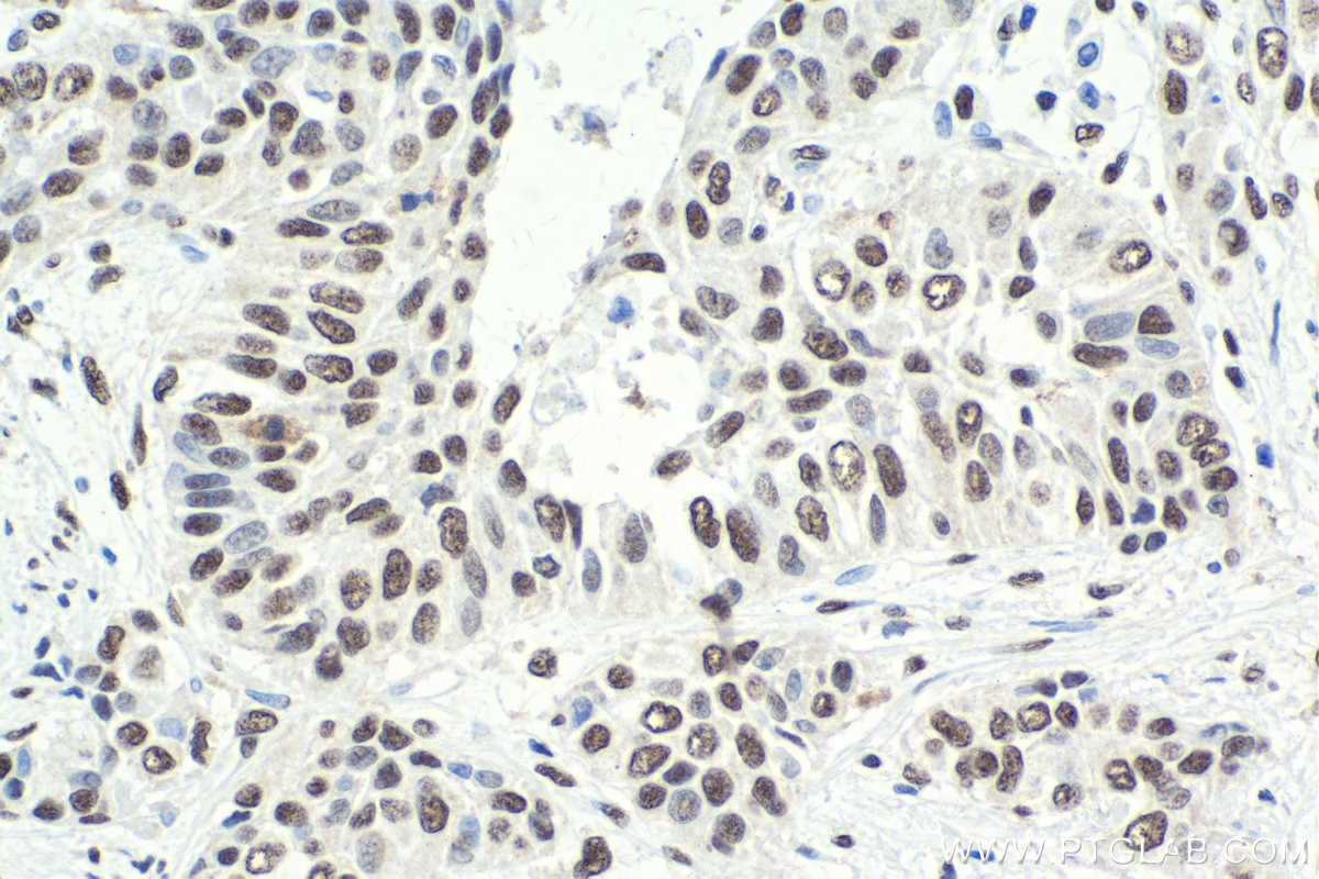 Immunohistochemical analysis of paraffin-embedded human urothelial carcinoma tissue slide using KHC1752 (SAFB IHC Kit).