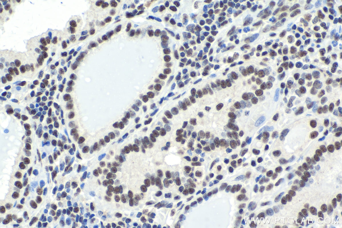 Immunohistochemical analysis of paraffin-embedded human thyroid cancer tissue slide using KHC1752 (SAFB IHC Kit).