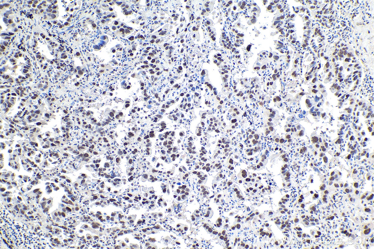 Immunohistochemical analysis of paraffin-embedded human lung cancer tissue slide using KHC1725 (SAFB2 IHC Kit).