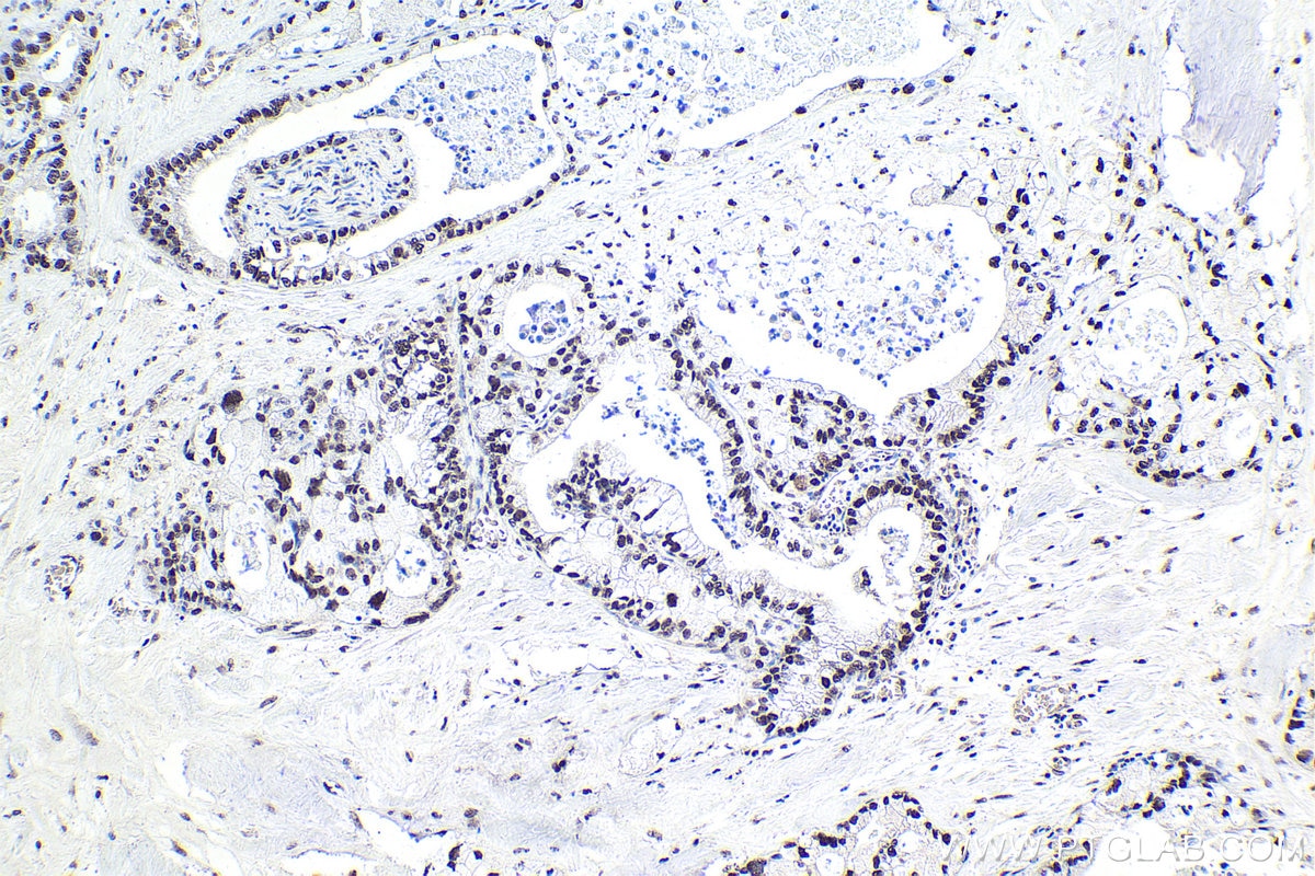 Immunohistochemical analysis of paraffin-embedded human pancreas cancer tissue slide using KHC1725 (SAFB2 IHC Kit).