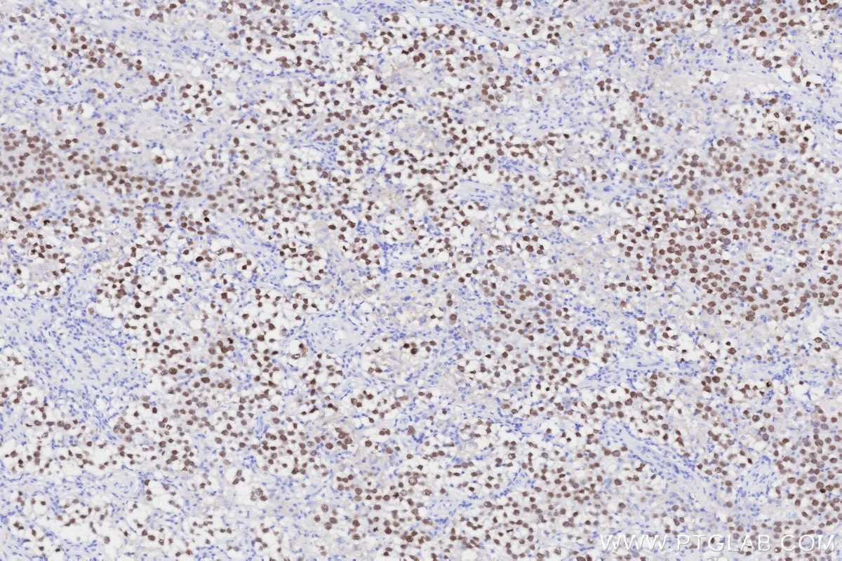 Immunohistochemical analysis of paraffin-embedded human seminoma tissue slide using KHC3312 (SALL4 IHC Kit).