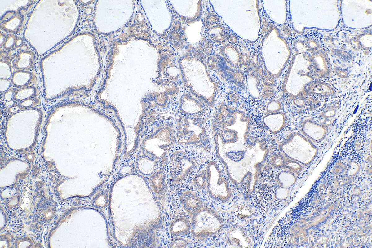 Immunohistochemical analysis of paraffin-embedded human thyroid cancer tissue slide using KHC1776 (SAMD4B IHC Kit).