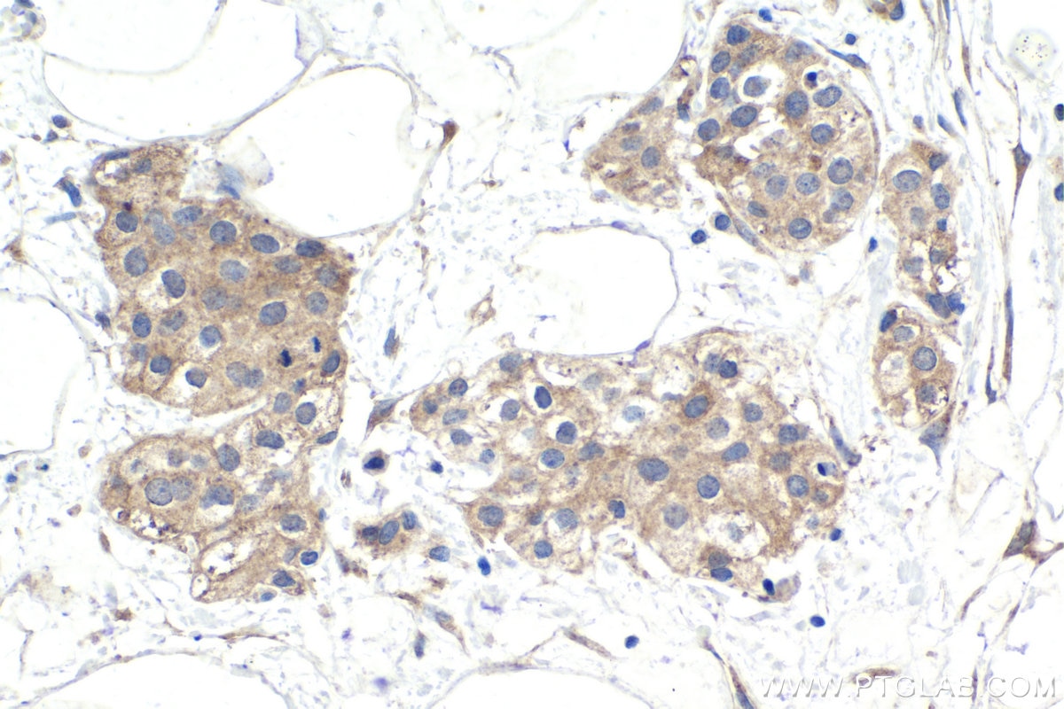 Immunohistochemical analysis of paraffin-embedded human urothelial carcinoma tissue slide using KHC1776 (SAMD4B IHC Kit).