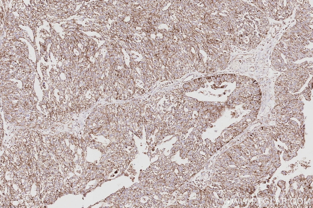 Immunohistochemical analysis of paraffin-embedded human ovary cancer tissue slide using KHC3075 (SAMM50 IHC Kit).