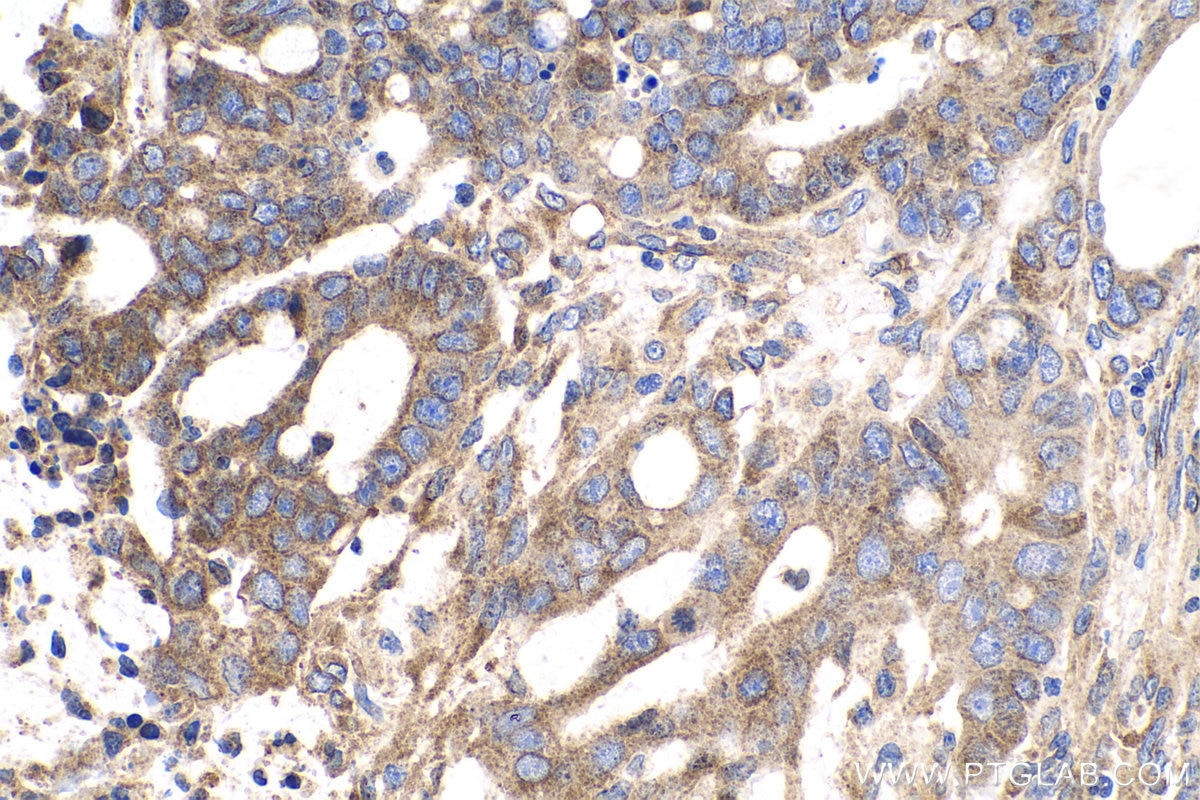 Immunohistochemical analysis of paraffin-embedded human colon cancer tissue slide using KHC0705 (SAR1A IHC Kit).