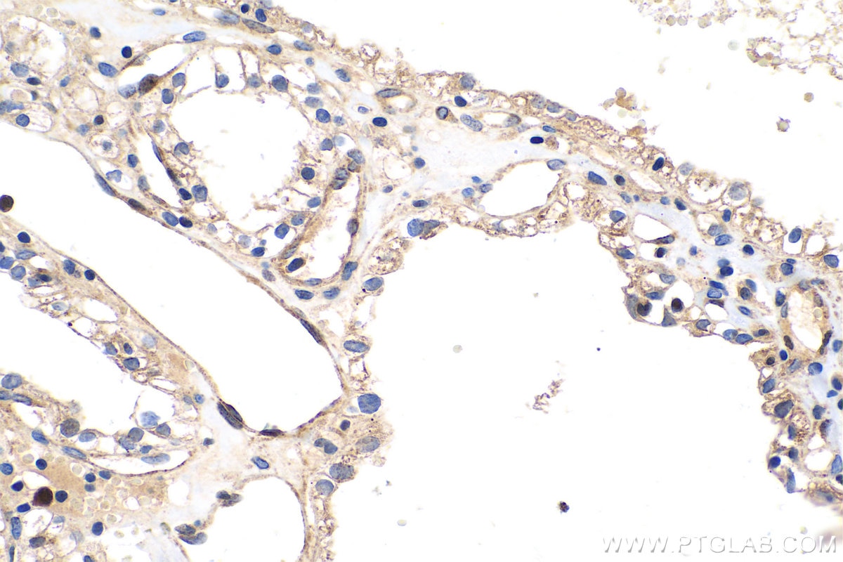 Immunohistochemical analysis of paraffin-embedded human renal cell carcinoma tissue slide using KHC0705 (SAR1A IHC Kit).