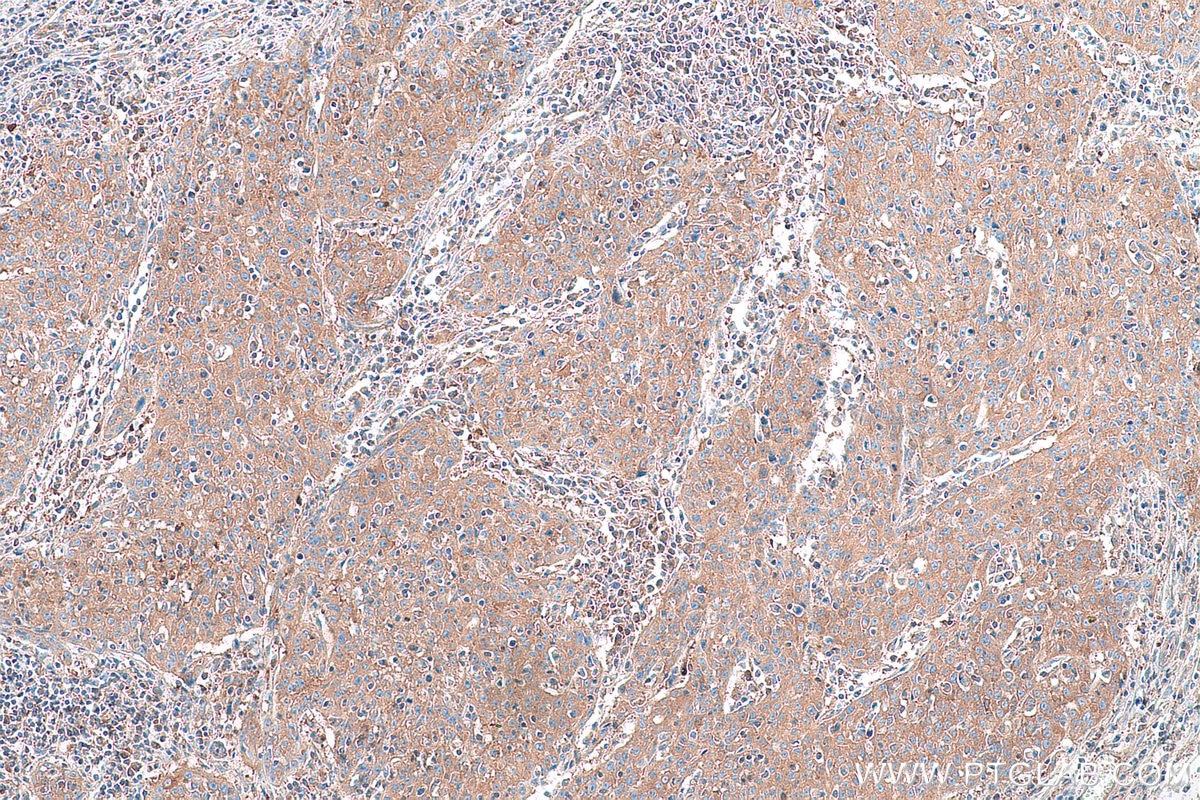 Immunohistochemical analysis of paraffin-embedded human cervical cancer tissue slide using KHC0952 (SARS IHC Kit).