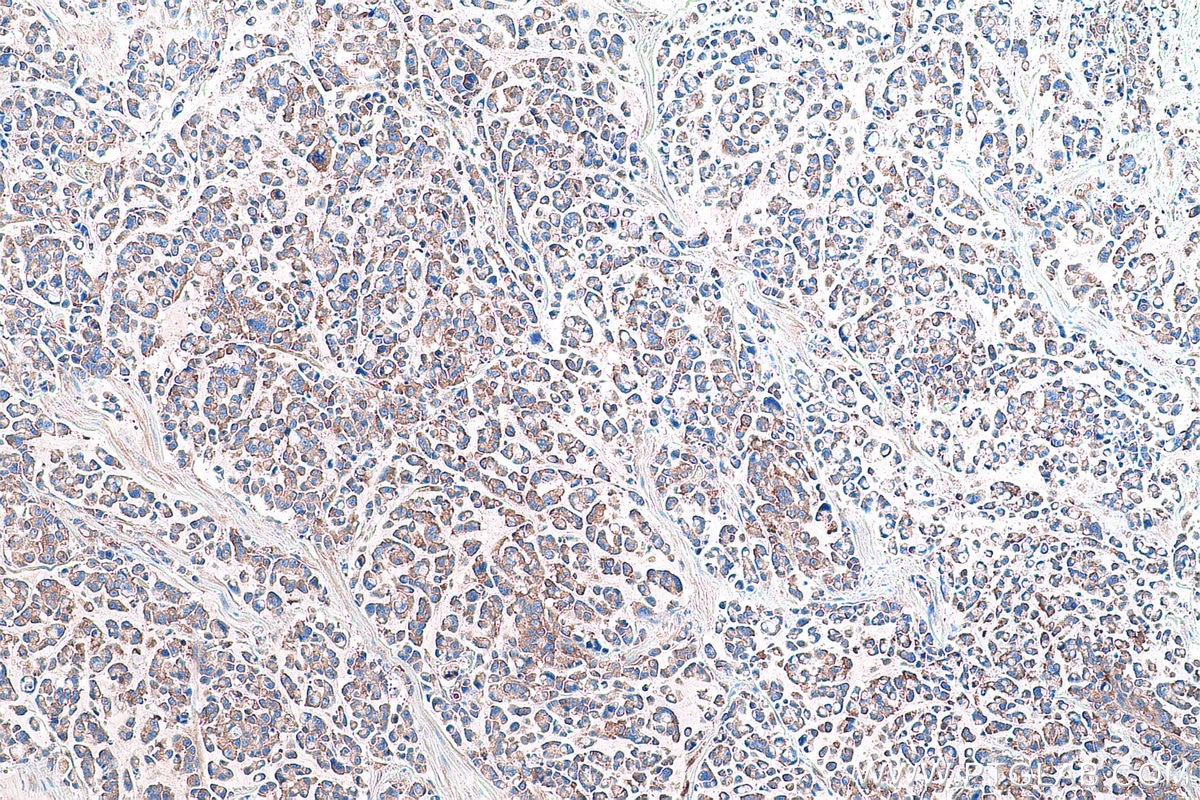 Immunohistochemical analysis of paraffin-embedded human colon cancer tissue slide using KHC0952 (SARS IHC Kit).