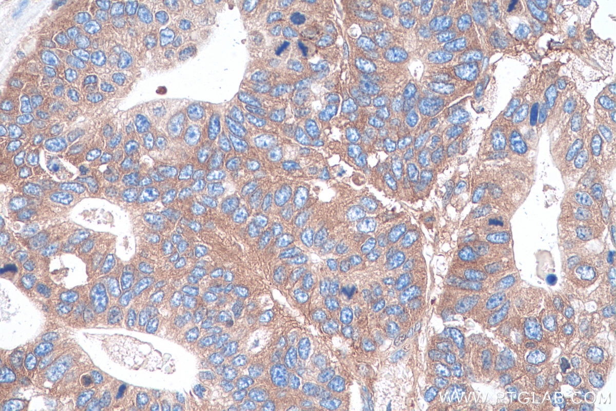 Immunohistochemical analysis of paraffin-embedded human stomach cancer tissue slide using KHC0952 (SARS IHC Kit).