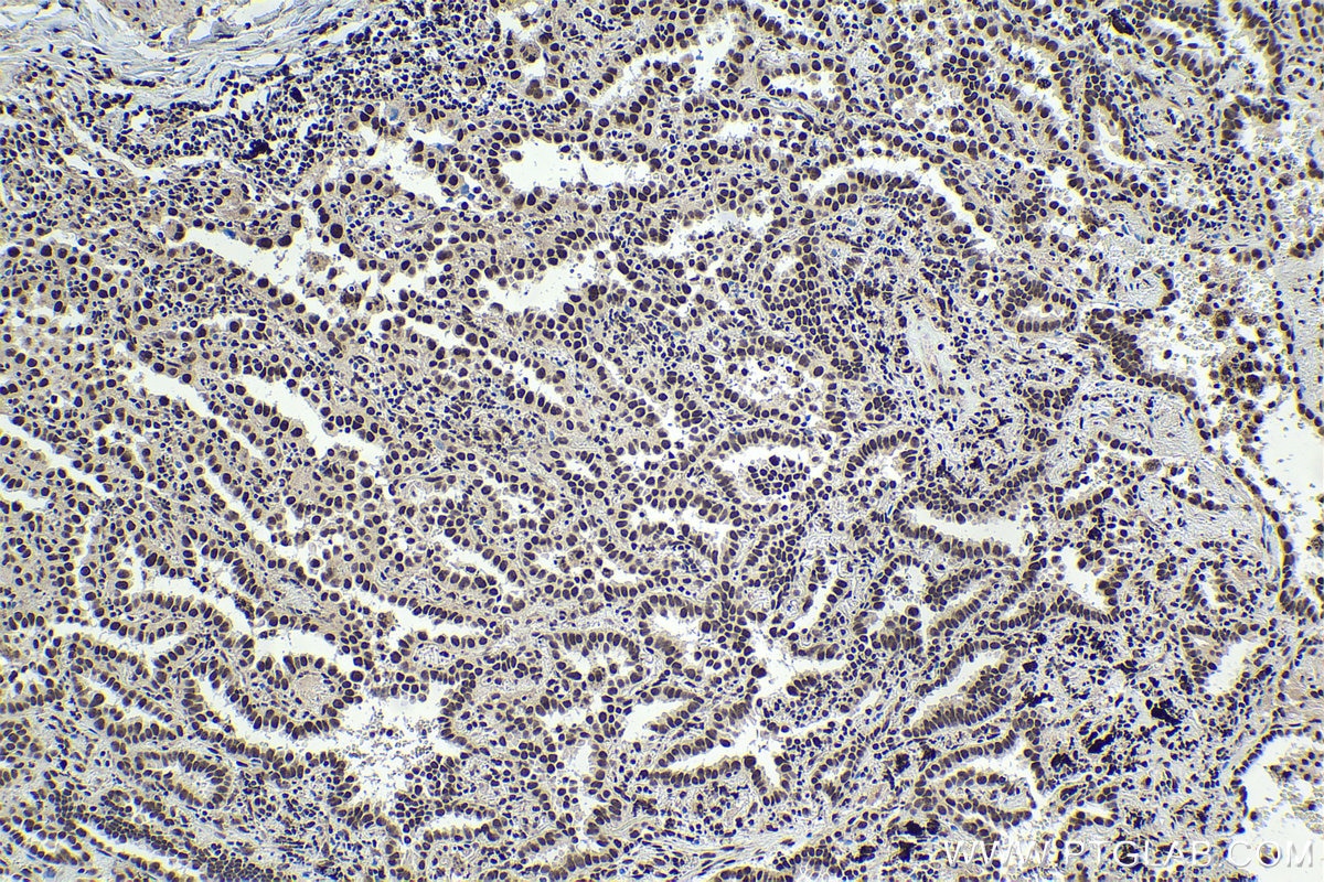 Immunohistochemical analysis of paraffin-embedded human lung cancer tissue slide using KHC1746 (SART3 IHC Kit).