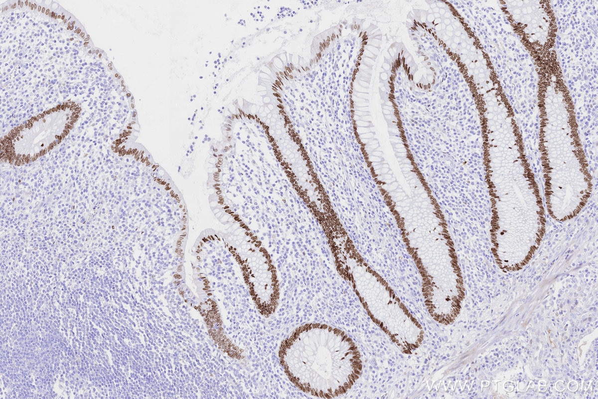 Immunohistochemical analysis of paraffin-embedded human appendicitis tissue slide using KHC3314 (SATB2 IHC Kit). Immunohistochemical analysis of paraffin-embedded human appendicitis tissue slide using KHC3314 (SATB2 IHC Kit).