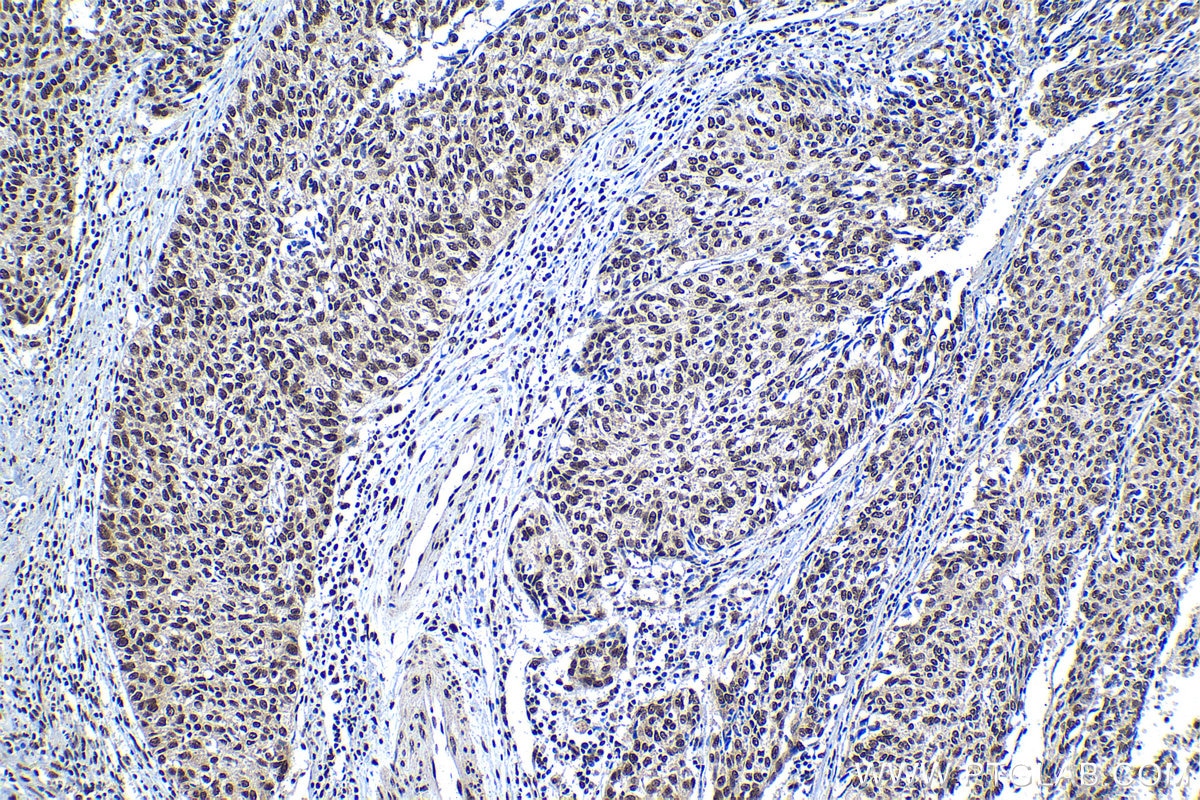 Immunohistochemical analysis of paraffin-embedded human cervical cancer tissue slide using KHC1286 (SCAF8 IHC Kit).