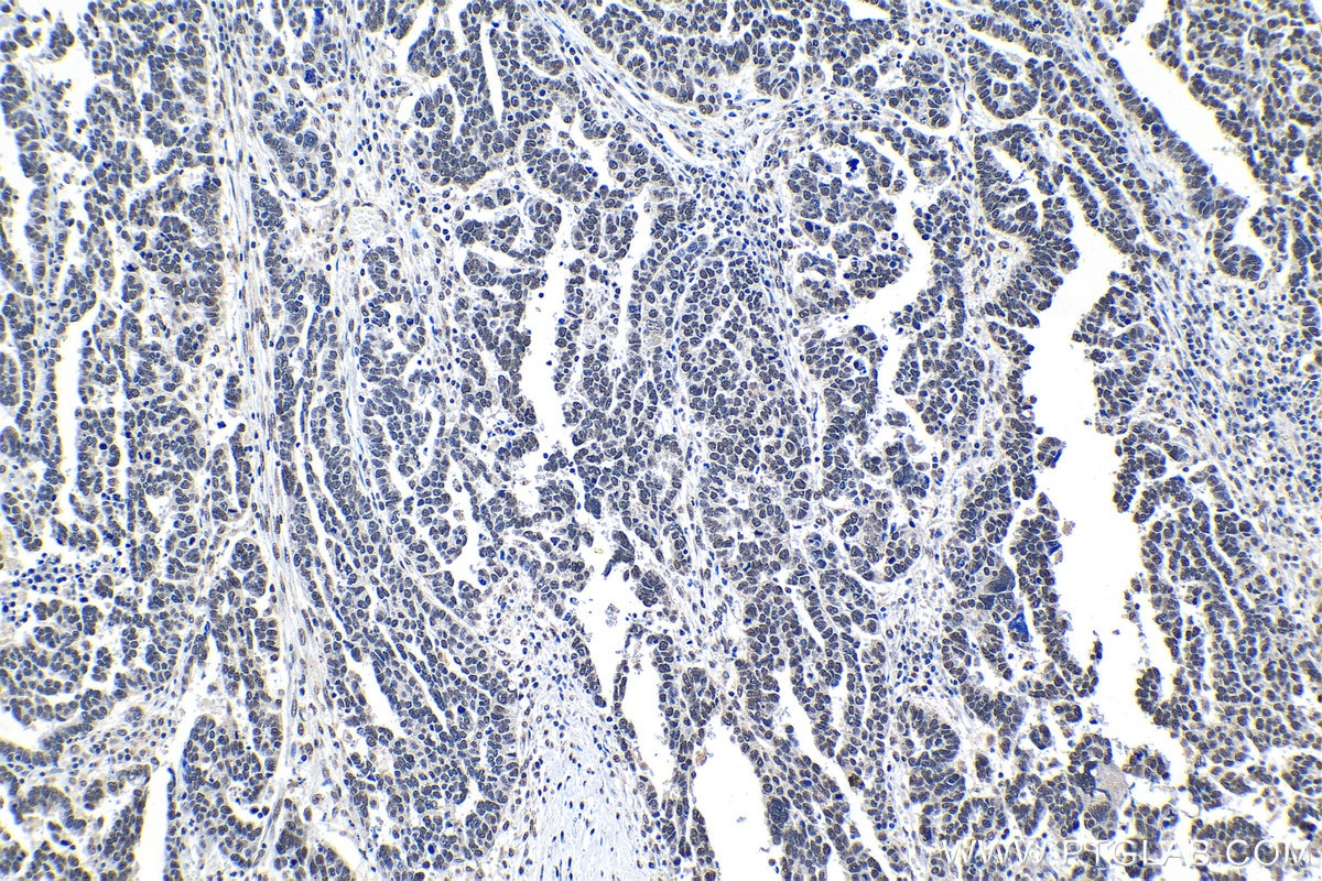 Immunohistochemical analysis of paraffin-embedded human ovary tumor tissue slide using KHC1286 (SCAF8 IHC Kit).
