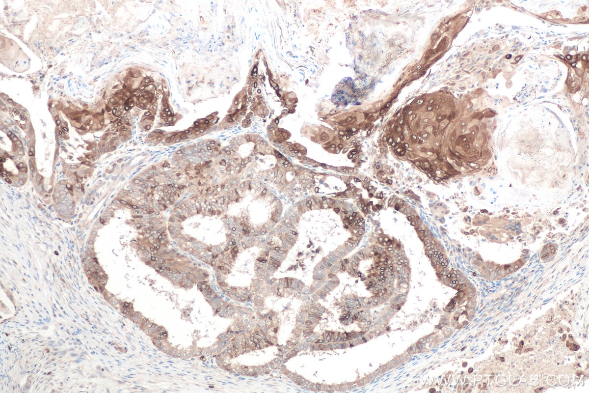 Immunohistochemical analysis of paraffin-embedded human ovary tumor tissue slide using KHC0814 (SCD IHC Kit).